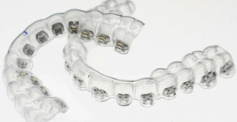 Indirect Bonding Trays